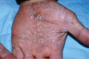 Secretaria orienta população a procurar Ambulatório DST-AIDS para prevenir-se da sífilis